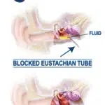 EarPopper® Middle Ear Inflation Device - Innovia Medical